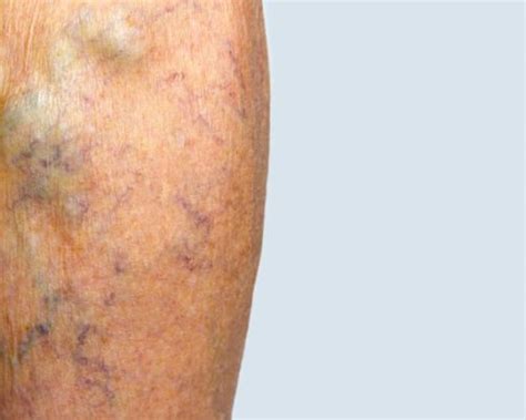 How To Know If You Should Treat Your Varicose Veins