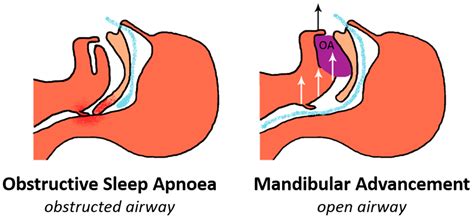jcm free full text oral appliance therapy for obstructive sleep apnoea state of the art