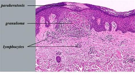 Αποτέλεσμα εικόνας για Lichen Nitidus Pathology Outline Pandora