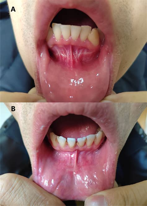 Figure 2 From Comparison Between Transoral Endoscopic Thyroidectomy