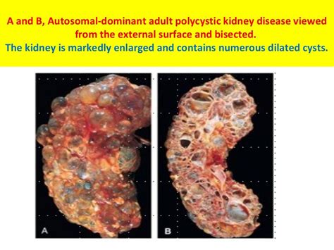 Polycystic Kidney Disease For Students