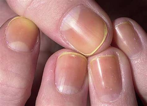 Things Your Fingernails Can Tell You About Your Health