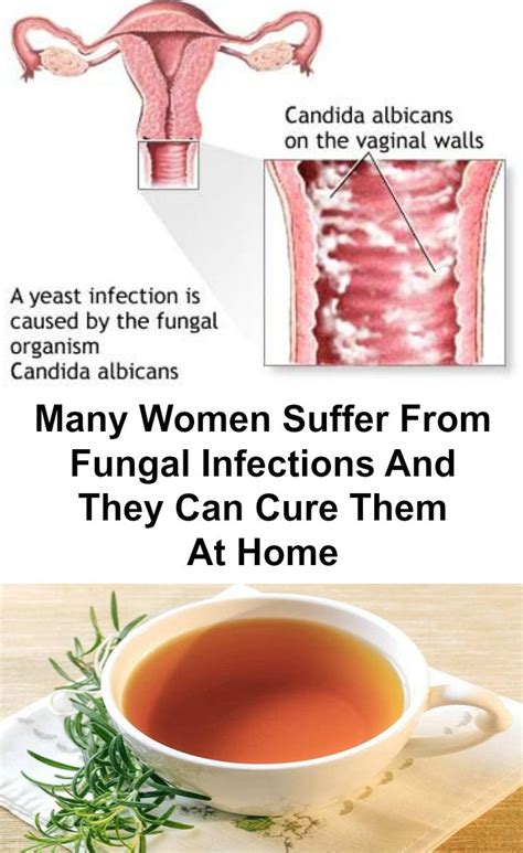 Many Women Suffer From Fungal Infections And They Can Cure Them At Home Yeast Infection