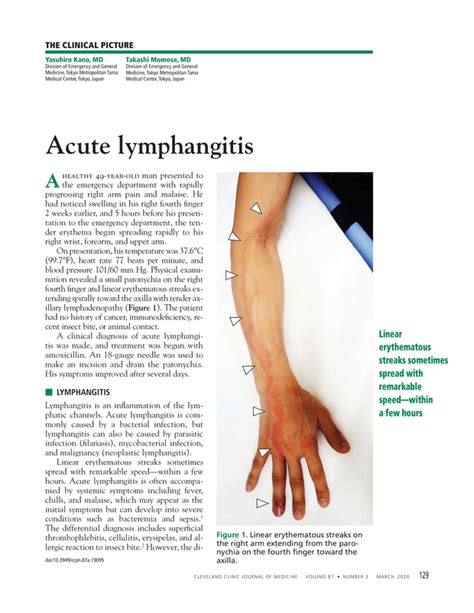 Acute Lymphangitis Cleveland Clinic Journal Of Medicine