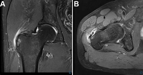 MRI Scans Of A Patient With Gluteal Tendinopathy And An MHIP Score Of 8
