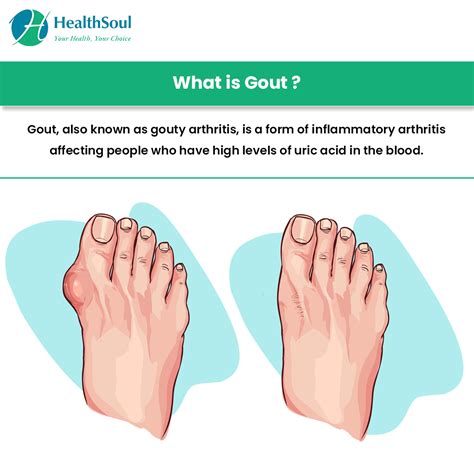 Gout Causes Symptoms And Treatment Healthsoul
