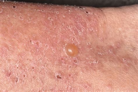 What Skin Rashes Can Be Spread By Breaking A Blister Orozco Antletch