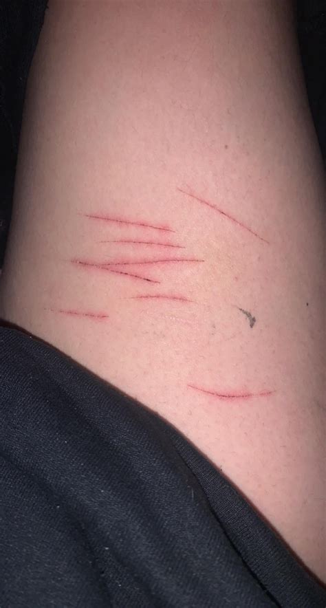 Tw — Week Old Sh Cuts Are These Infected Or Are They Just Not Being
