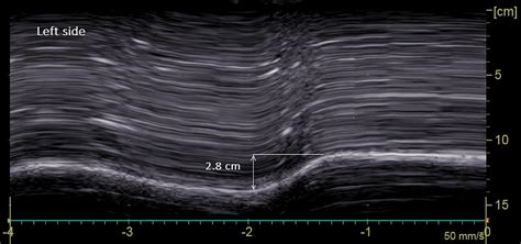 Frontiers Diaphragm Dysfunction After Severe Covid 19 An Ultrasound