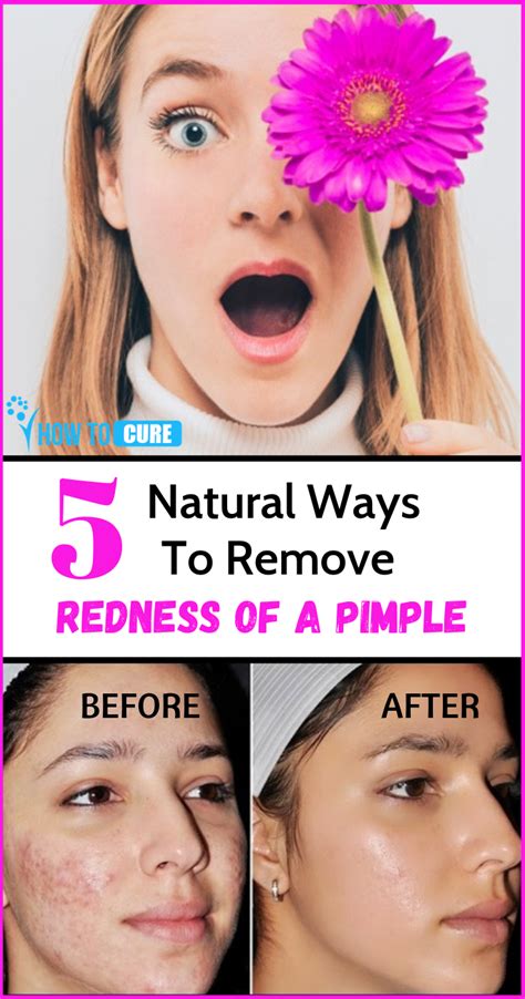 10 Ways To Get Rid Of A Pimple Overnight In 2020 Reduce Pimple