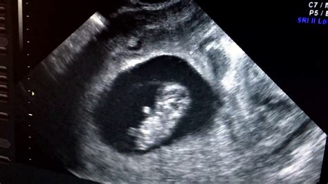 First Trimester Ultrasound Video Baby Is Waving At Us Youtube