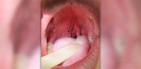 About Peritonsillar Abscess Ear Nose Throat And Dental Problems