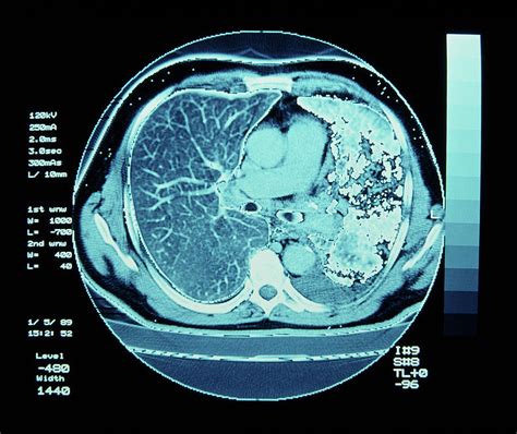 Ct Scan On Chest Showing Lung Cancer By Simon Fraserscience Photo Library