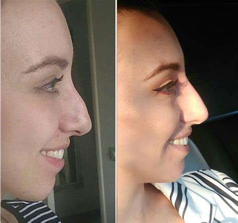 How My Non Surgical Nose Job Changed My Life