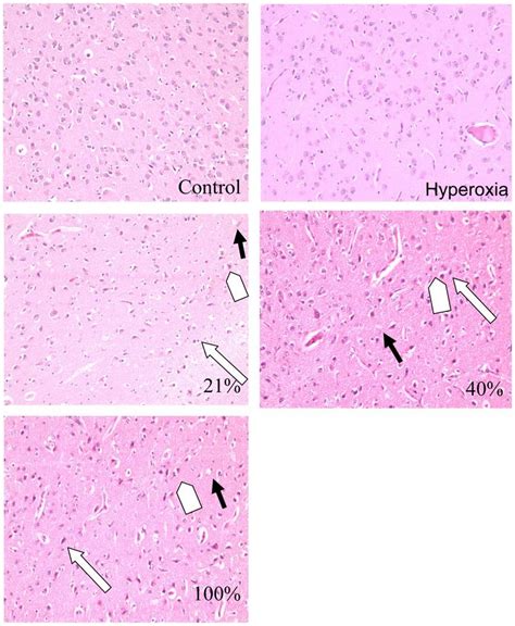 Brain Histopathology Typical Morphological Changes After Hypoxia And
