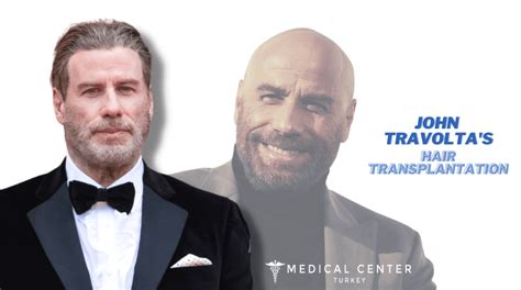 John Travolta S Hair Transplantation MCT