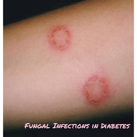 Diabetes And Fungal Infections Dr Nikhil Prabhus Blog Diabetes Care