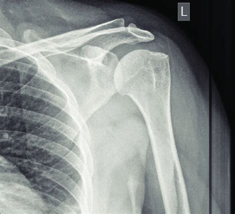 X Ray Normal Shoulder