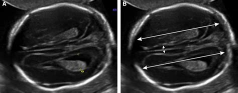 Agenesis Of The Corpus Callosum American Journal Of Obstetrics