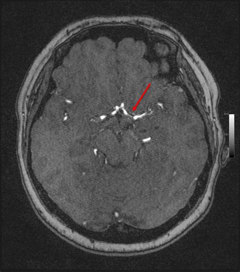 Young Stroke With Mca Stenosis Radiology Cases