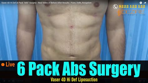 Vaser 4d Hi Def 6 Pack Abs Surgery Before And After Results Pune Delhi Bangalore