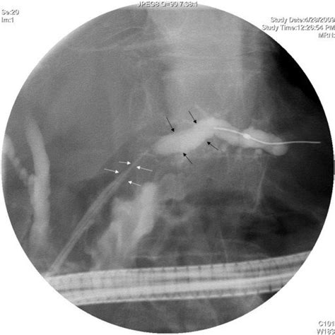 Ercp Showing The 7f 10 Cm Long Pancreatic Stent Traversing The Main Download Scientific
