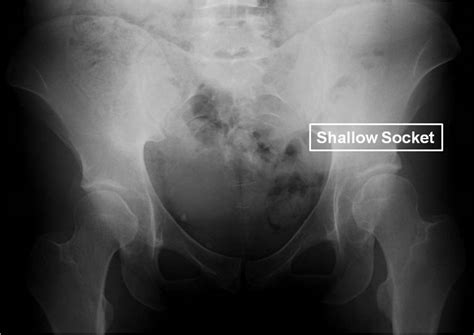 Pao Surgery To Treat A 29 Year Old Female With Hip Dysplasia And A