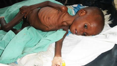 Malnutrition In Children On The Rise In Iganga Daily Monitor