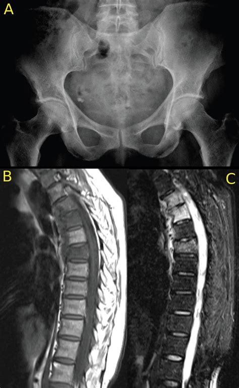Imaging Of Axial Psoriatic Arthritis The Rheumatologist
