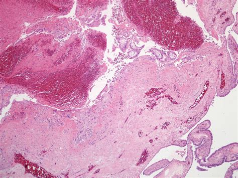 Pathology Outlines Ectopic Tubal Pregnancy