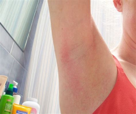 Circular Rash Under Armpit