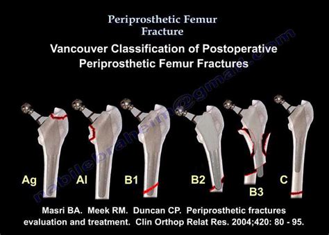 Femur Fracture Periprosthetic Fracture Everything You Need To Know Hip Replacement