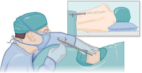 Diagnostic Thoracic Surgical Procedures Thoracoscopy Vats And