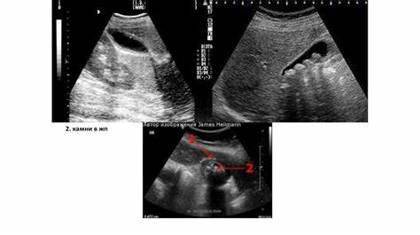 Хронический холецистит - презентация онлайн Картинка - Хронический холецистит - презентация онлайн