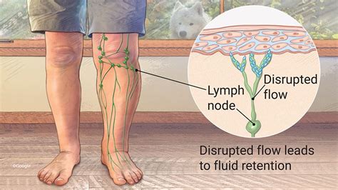 Lymphedema Illustration By Laurie Okeefe Medical Illustration