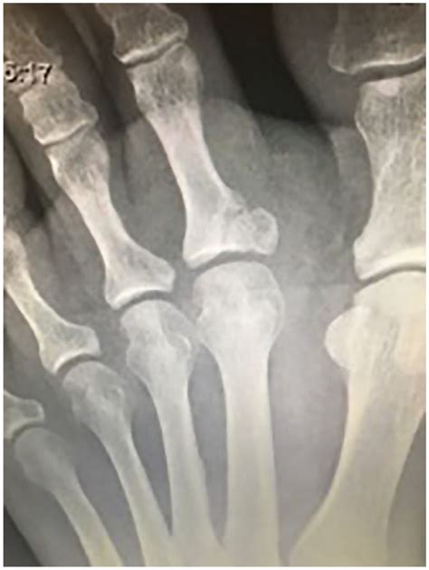 Case Report And Surgical Technique Second Toe Intra Articular Proximal Phalanx Fracture