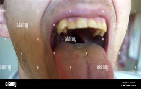 Boy Uvula Hi Res Stock Photography And Images Alamy