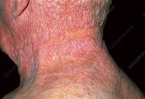 Lichenification Caused By Eczema On A Mans Neck Stock Image M150