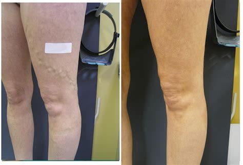 Varicose Vein Removal Melbourne Leg Ulcer Removal Gallery