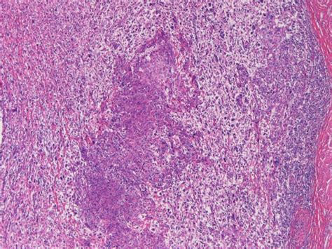 Urinary Bladder Carcinoma With Triplicate Differentiations Into Giant