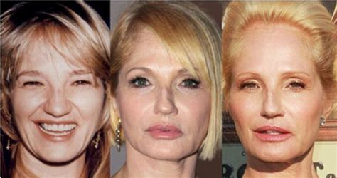 Ellen Barkin Plastic Surgery Before And After Pictures
