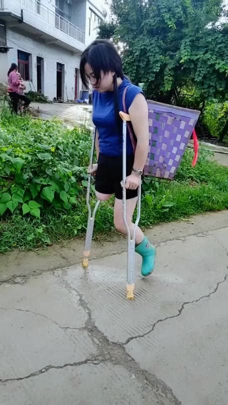 Amputee Legs Stumps And Prostheses — Onelegged Chinese Girl On