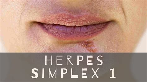 Herp Oral Herpes Triggers Diagnosis And Treatment Stories Highlights