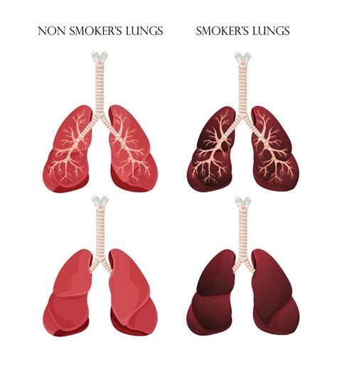 Illustration Of Normal Healthy Lungs And Lungs Smoker Concept Of Stop