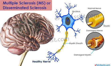 A review of available treatment options. Multiple Sclerosis or Disseminated Sclerosis|Types|Risk ...