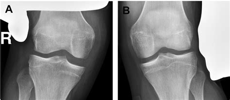 The Role Of Osteotomy In Chronic Valgus Instability And Hyperextension