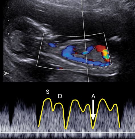 A Radiologist’s Guide To The Performance And Interpretation Of Obstetric Doppler Us Radiographics