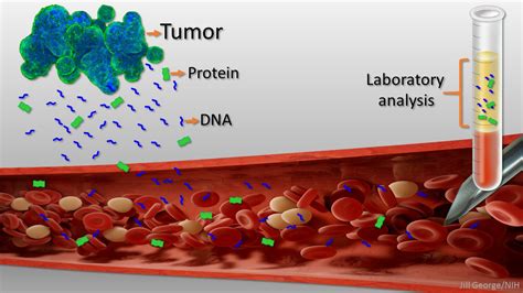 New Liquid Biopsy Shows Early Promise In Detecting Cancer Exosome Rna