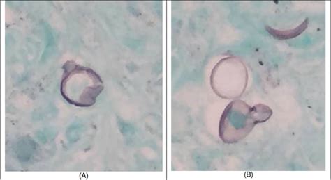 Disseminated Blastomycosis In A Patient With Polycythemia Vera On