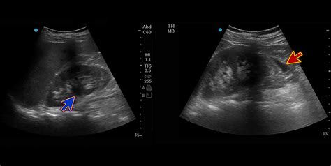 Cureus Appendicitis Mimicking Urinoma A Challenging Emergency